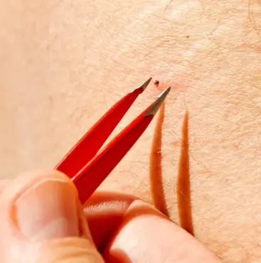 Pessoa remove carrapato com pinça