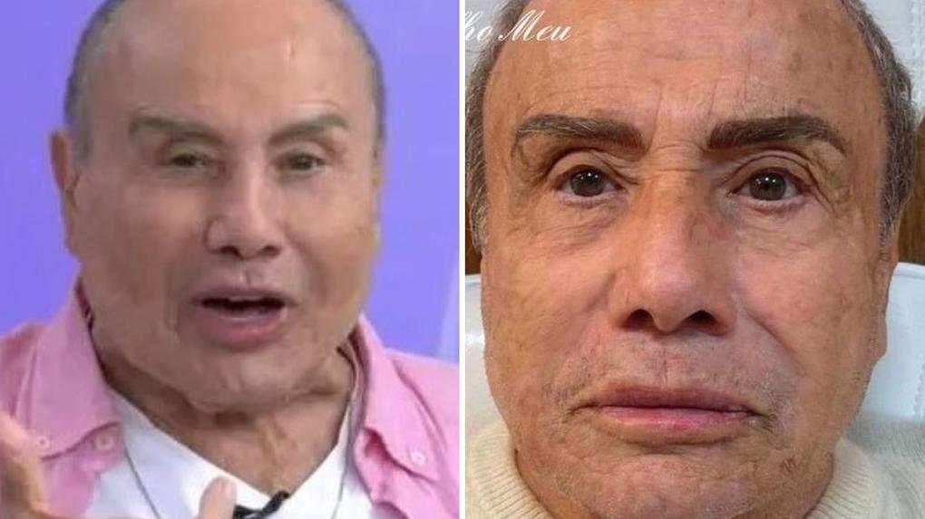 O ator Stênio Garcia viralizou nas redes sociais após mostrar o resultado do procedimento em um programa de TV