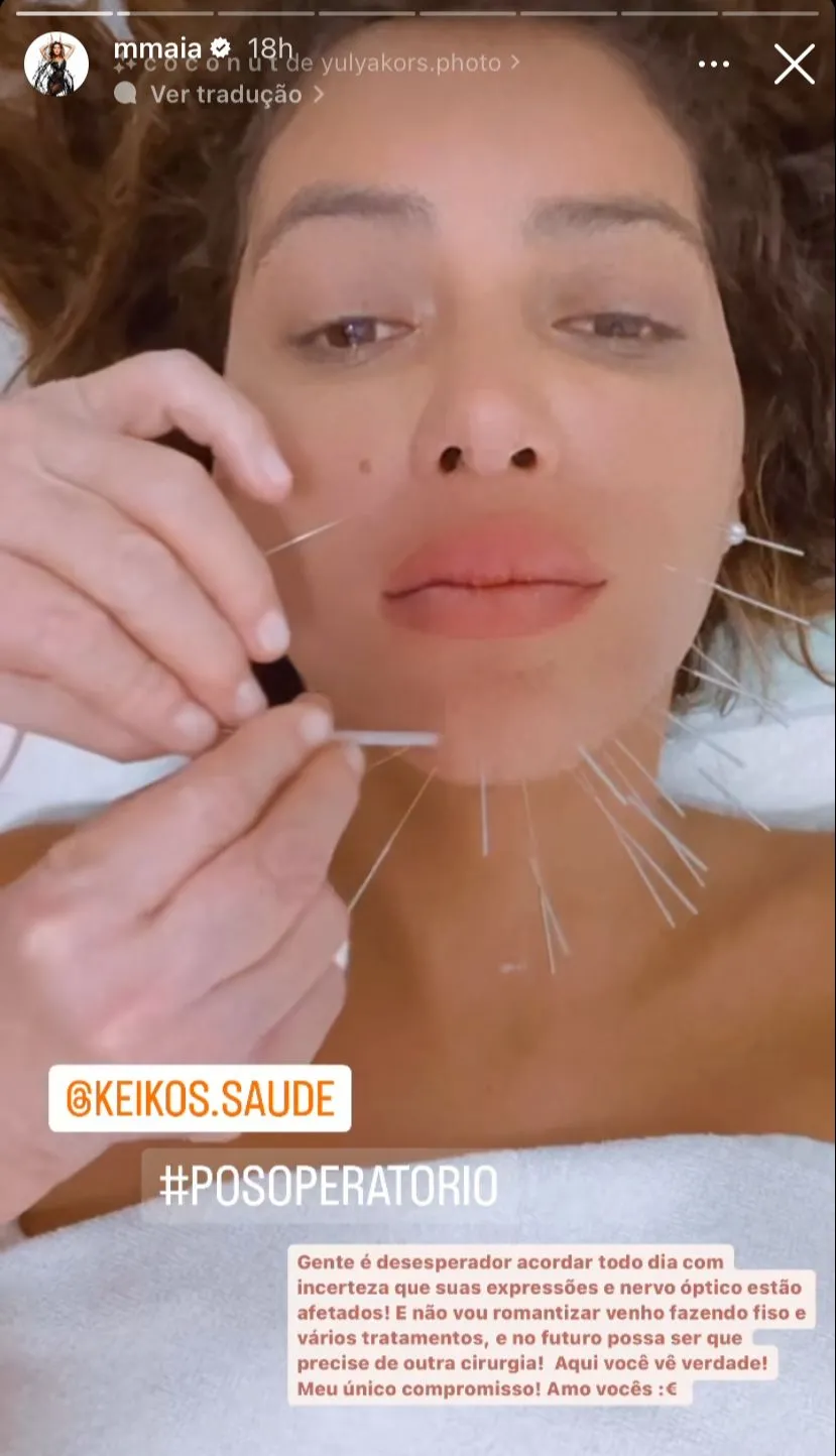 A atriz compartilha com os seguidores a rotina de tratamento da paralisia facial