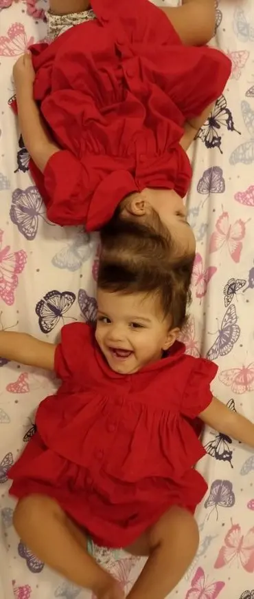 Gêmeas siamesas já passaram por quatro cirurgias