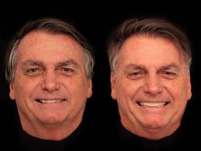 Montagem mostra antes e depois de Jair Bolsonaro após colocar lente nos dentes