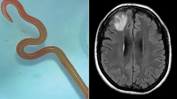 Paciente que teve verme de 8 centímetros, comum em cobras-píton no cérebro, teve perda de memória e depressão