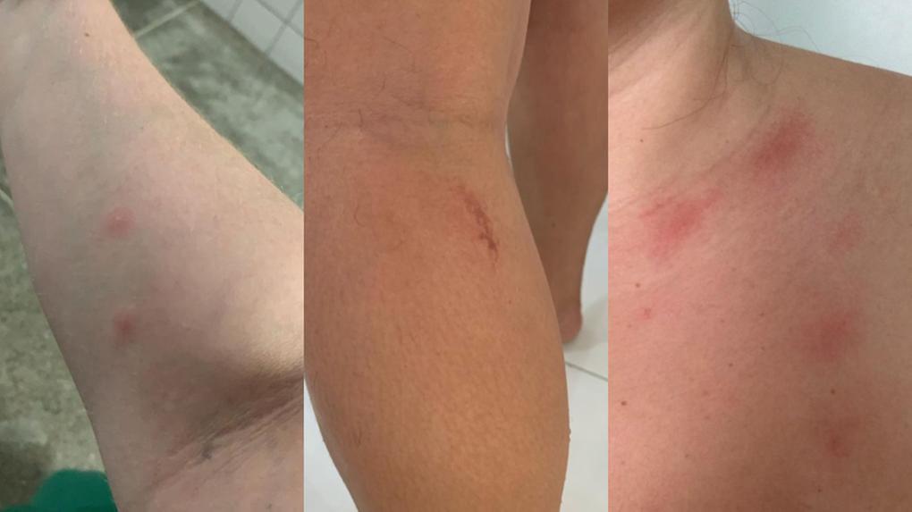 Lesões e alergias em peles de profissionais da UPA Canindezinho após infestação de pulgas