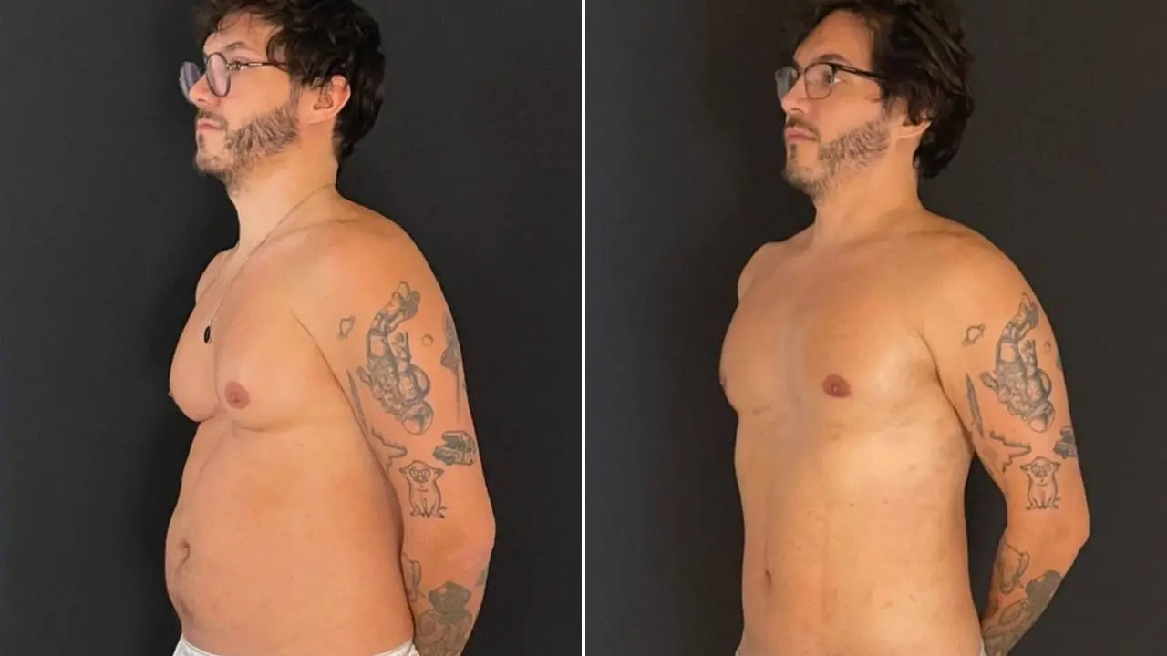 Eliezer mostra antes e depois de ginecomastia e de lipoaspiração