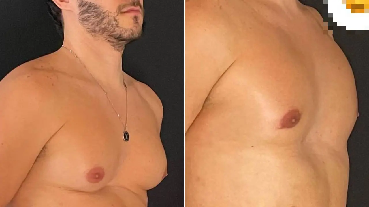 Eliezer mostra antes e depois de ginecomastia