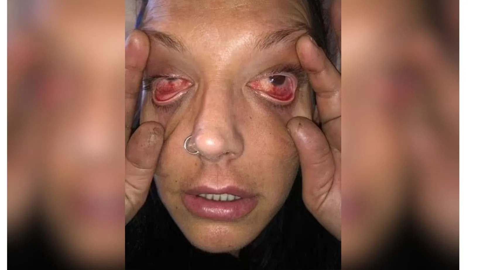 Mulher atingida por detergente industrial teve 90% de danos na região dos olhos