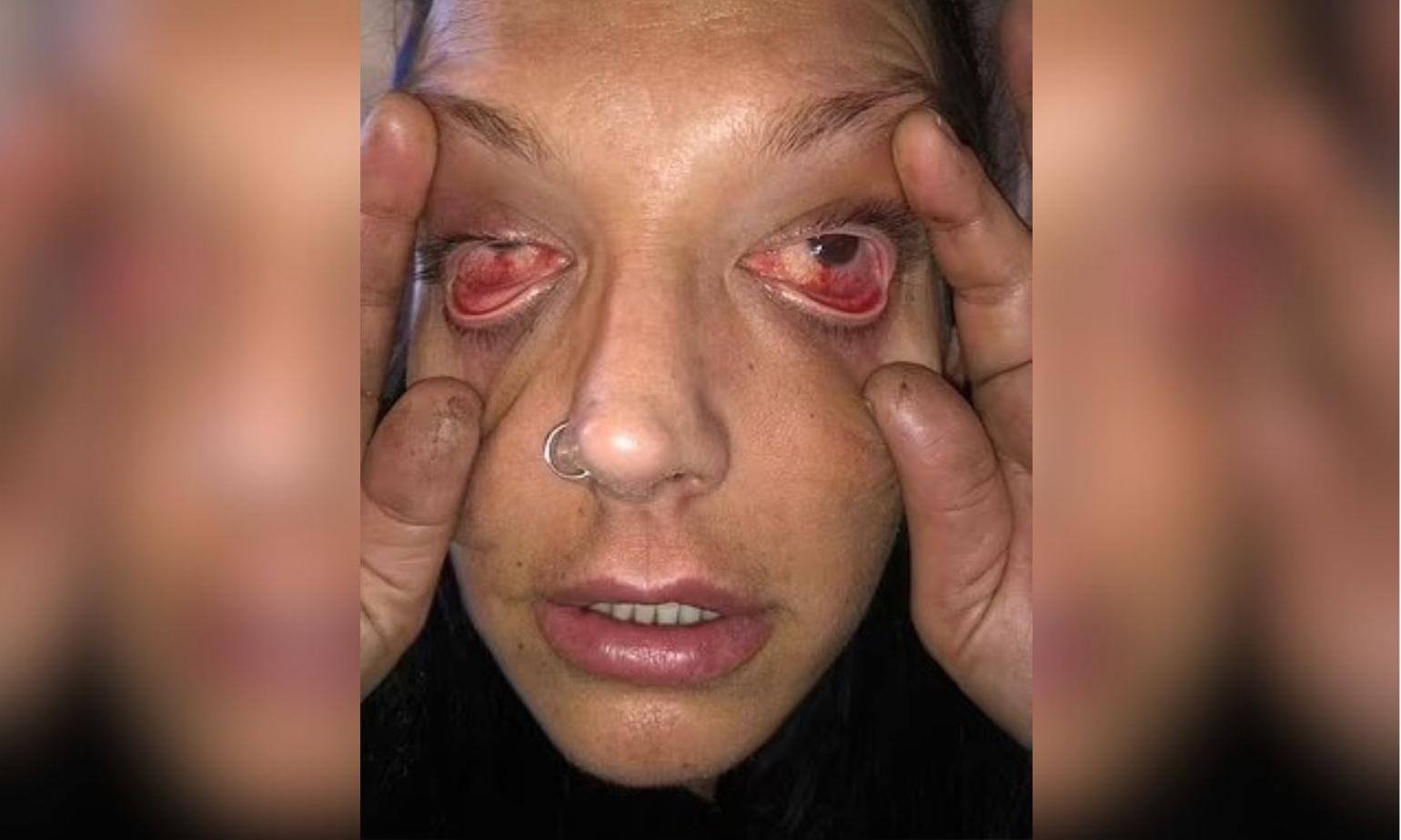 Montagem de mulher que teve olhos atingidos por detergente industrial