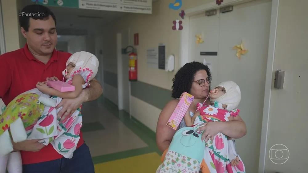 Gêmeas siamesas que nasceram unidas pelo crânio foram separadas após quatro cirurgias