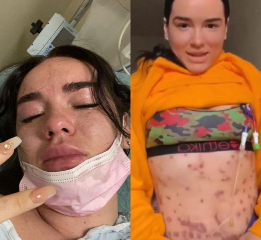 Imagem da influencer americana com a bactéria comedora de carne