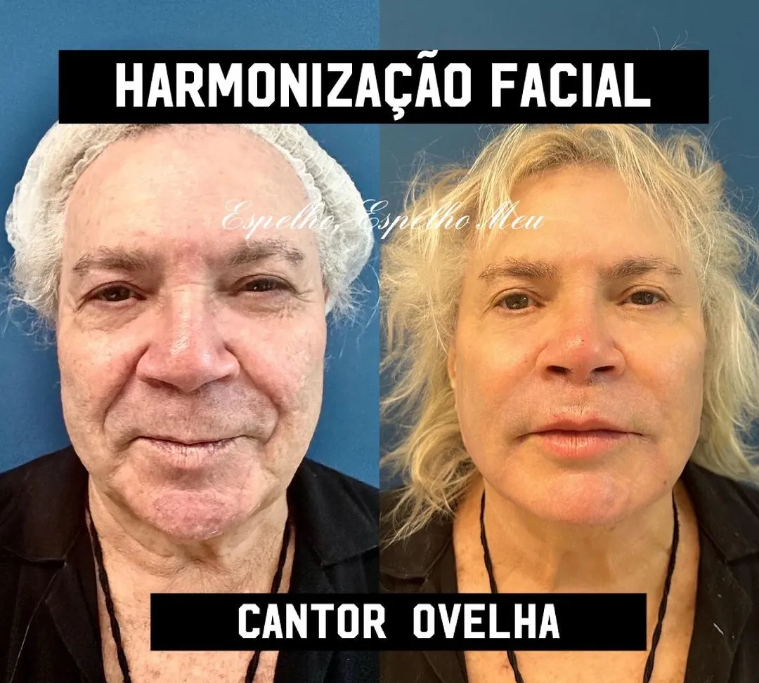 Cantor Ovelha compartilhou o antes e depois da harmonização facial dele