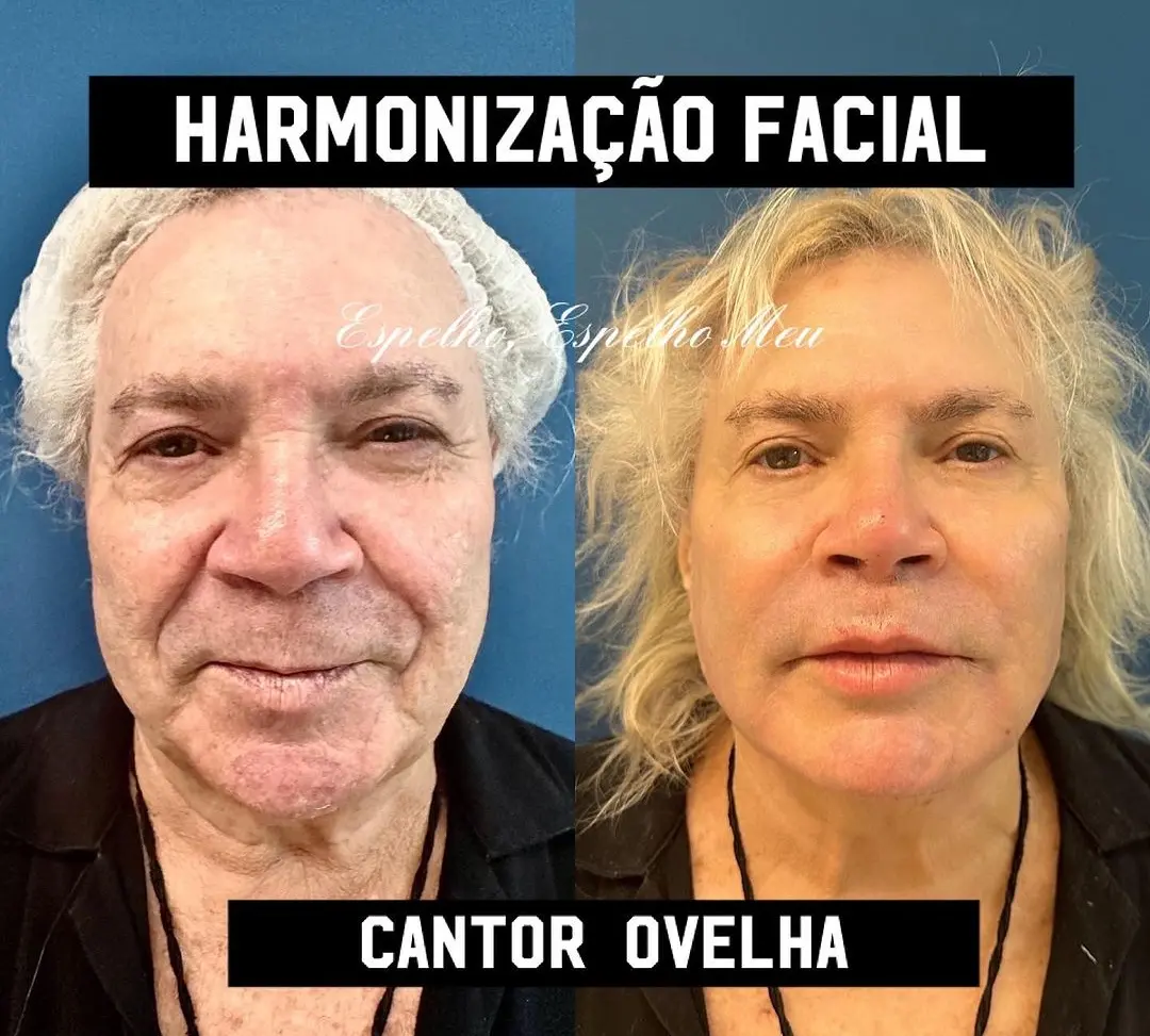 Antes e depois do cantor Ovelha