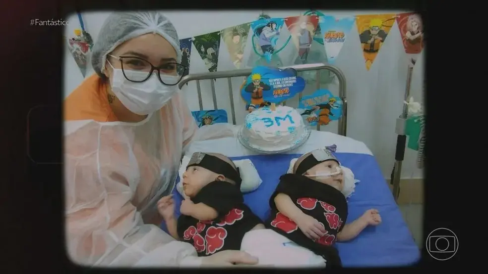 Gêmeos siameses Jairo e Gabriel, nascidos ligados pela coluna, ao lado de profissional da saúde no hospital da Criança Conceição, em Porto Alegre, Rio Grande do Sul. Gêmeos siameses nascidos ligados pela coluna desafiam médicos em cirurgia de separação; conheça história