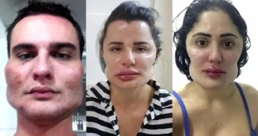 Vítimas pagaram por uma harmonização facial