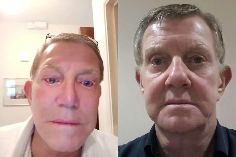 Elderly man spends four years without closing his eyes after plastic surgery: ‘You ruined my life’ – World