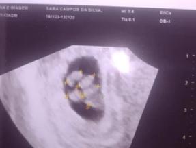 Ultrassonografia mostra embrião dividido em 5