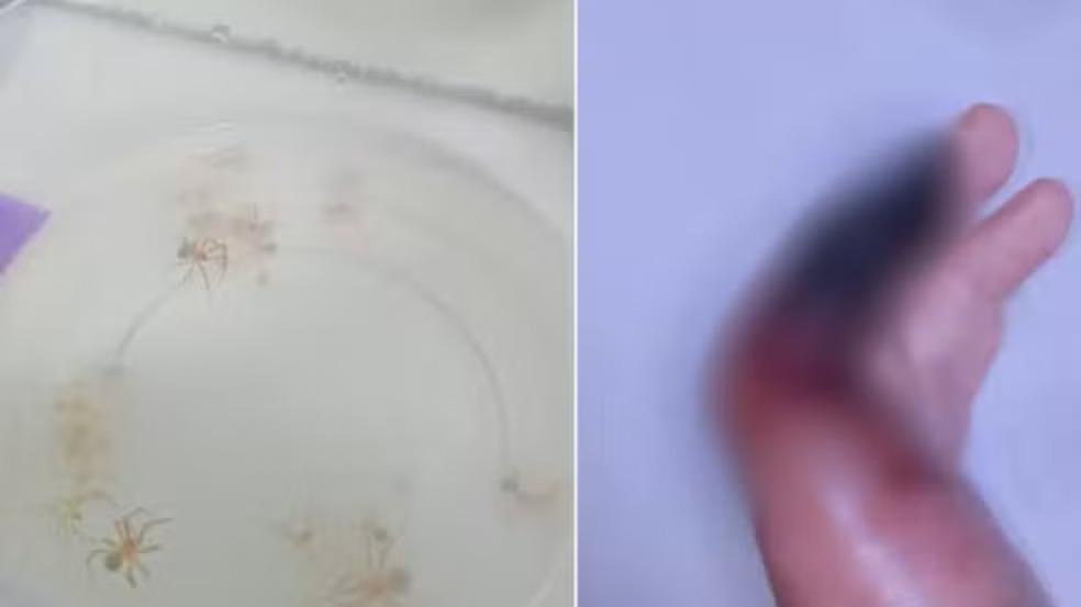 Foto de aranha-marrom coletada por homem picado por ela e, ao lado, oto do dedo necrosado da vítima