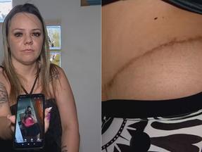 Paciente Luana Fantinel teve problemas de cicatrização após passar por cirurgia plástica com Leandro Fuchs