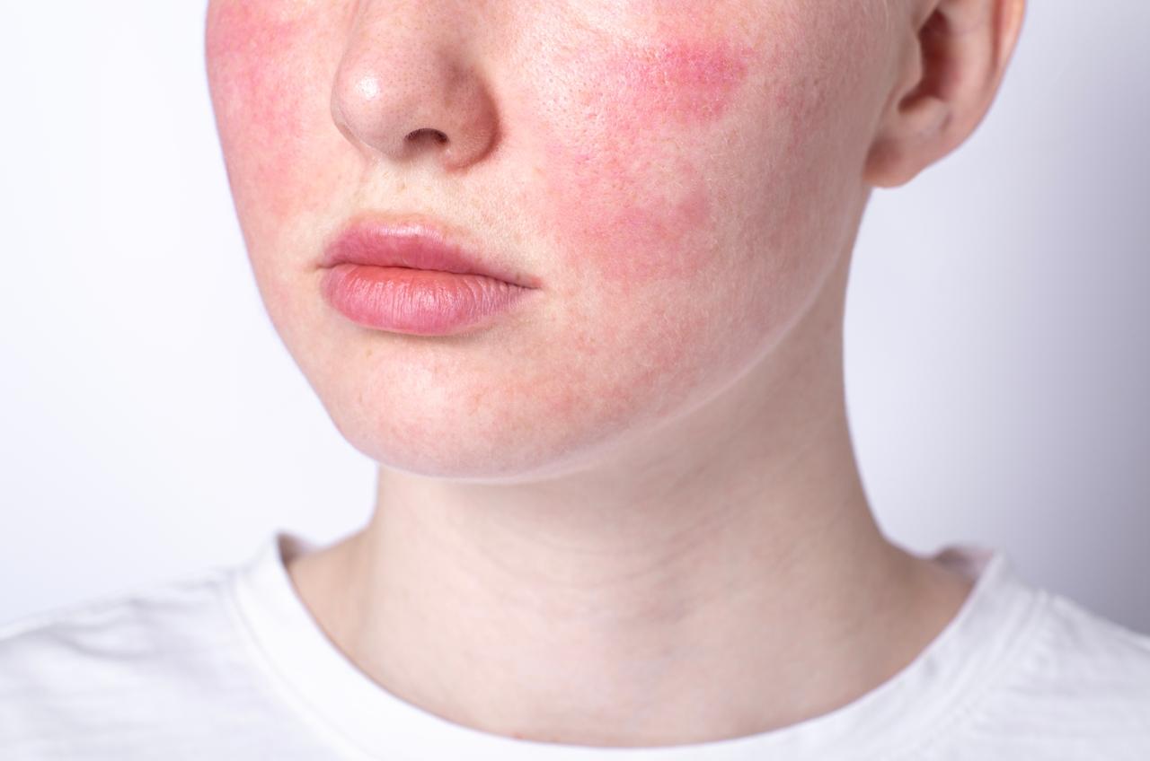 Maquiagem de má qualidade ou vencida pode causar alergias e outros problemas de pele