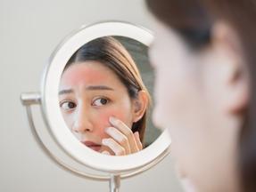 Uma jovem asiática que olha a pele do rosto no espelho tem uma erupção vermelha no rosto devido a alergia cosmética. Adolescente de 13 anos quase perde a visão após seguir tutorial de skin care do TikTok