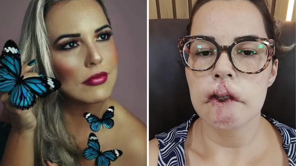 Montagem de fotos mostra a mulher que perdeu os lábios antes e depois