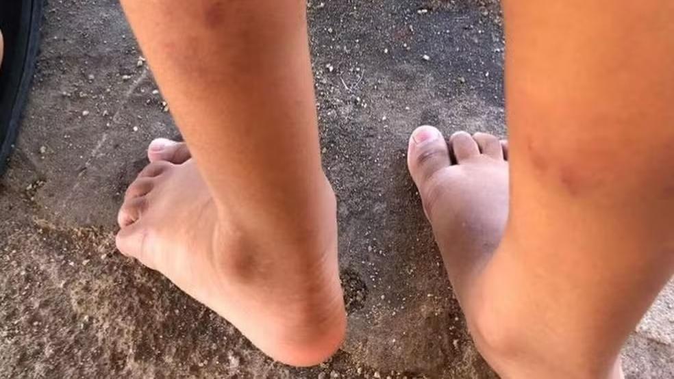 Pernas de criança com marcas de mordida
