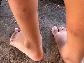 Pernas de criança com marcas de mordida