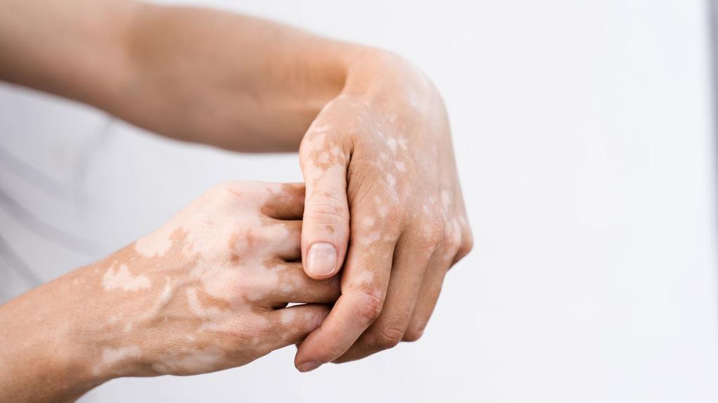 mãos com vitiligo