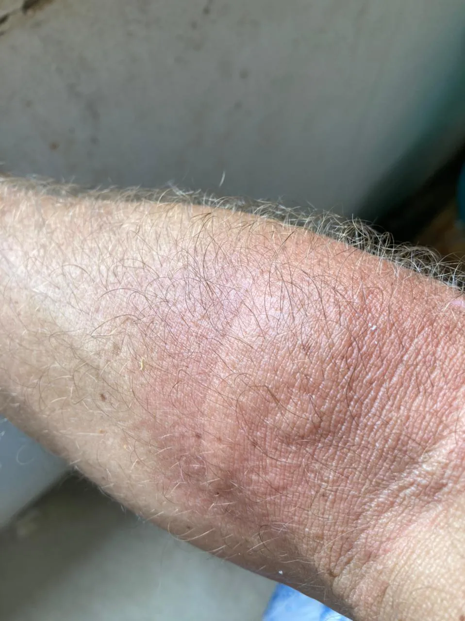 Contato com água-viva deixou uma lesão na pele do corretor de imóveis