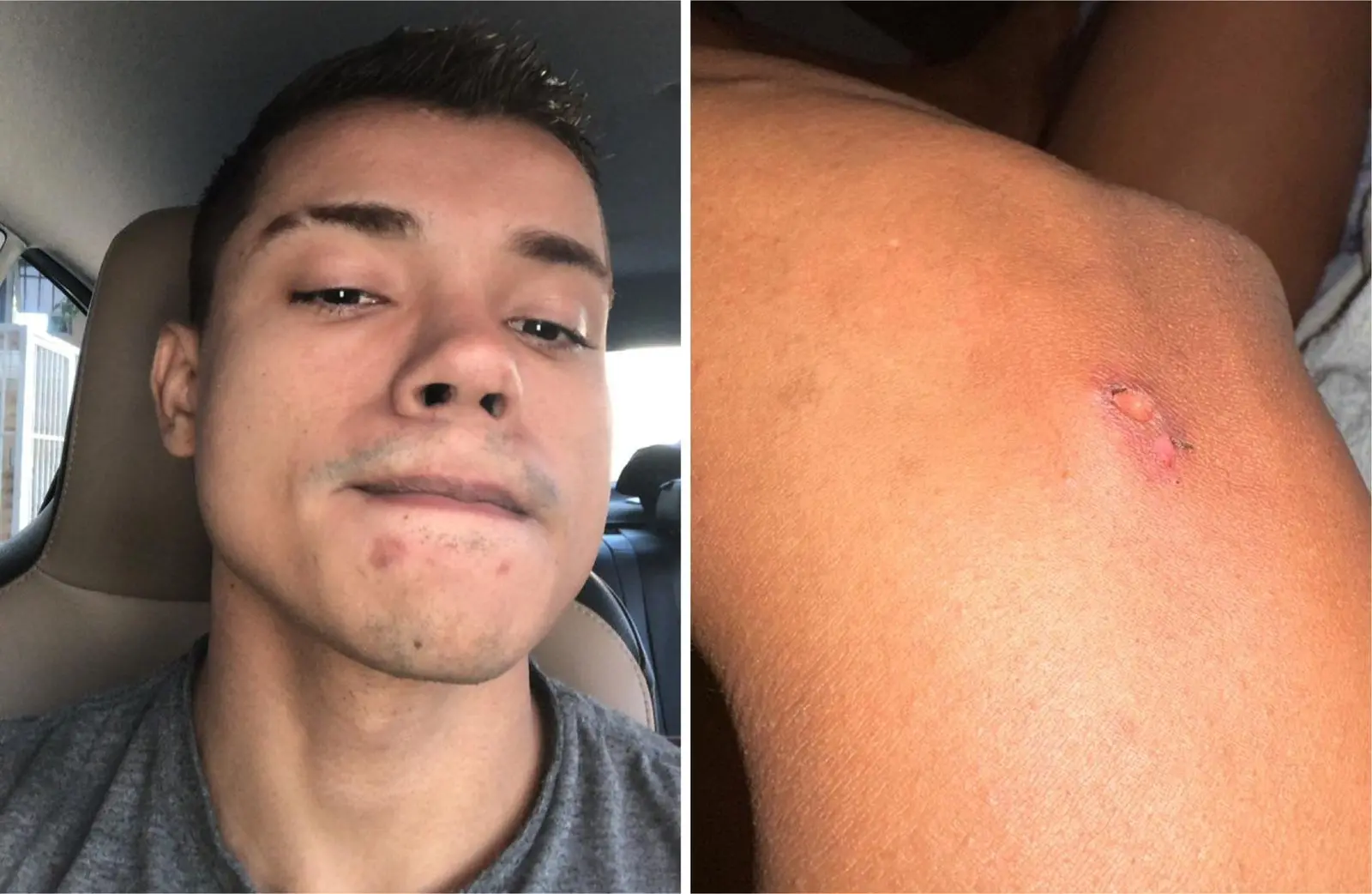Montagem de fotos mostra Alex de rosto à esquerda e uma parte de sua pele queimada à direita