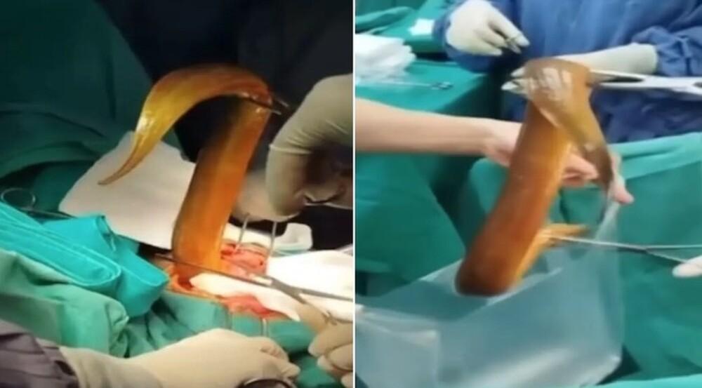 Médicos em cirurgia para retirar enguia viva de 60cm do corpo de paciente no Vietnã