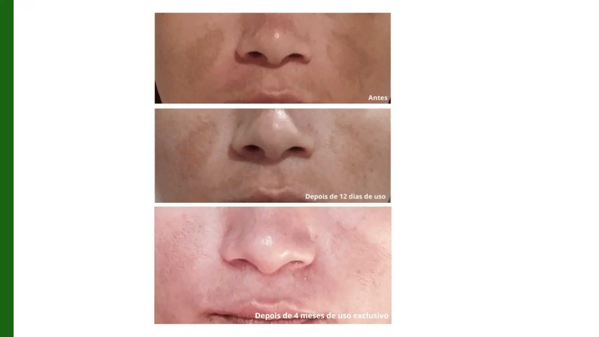 Imagem de paciente com melasma / tratamento de melasma