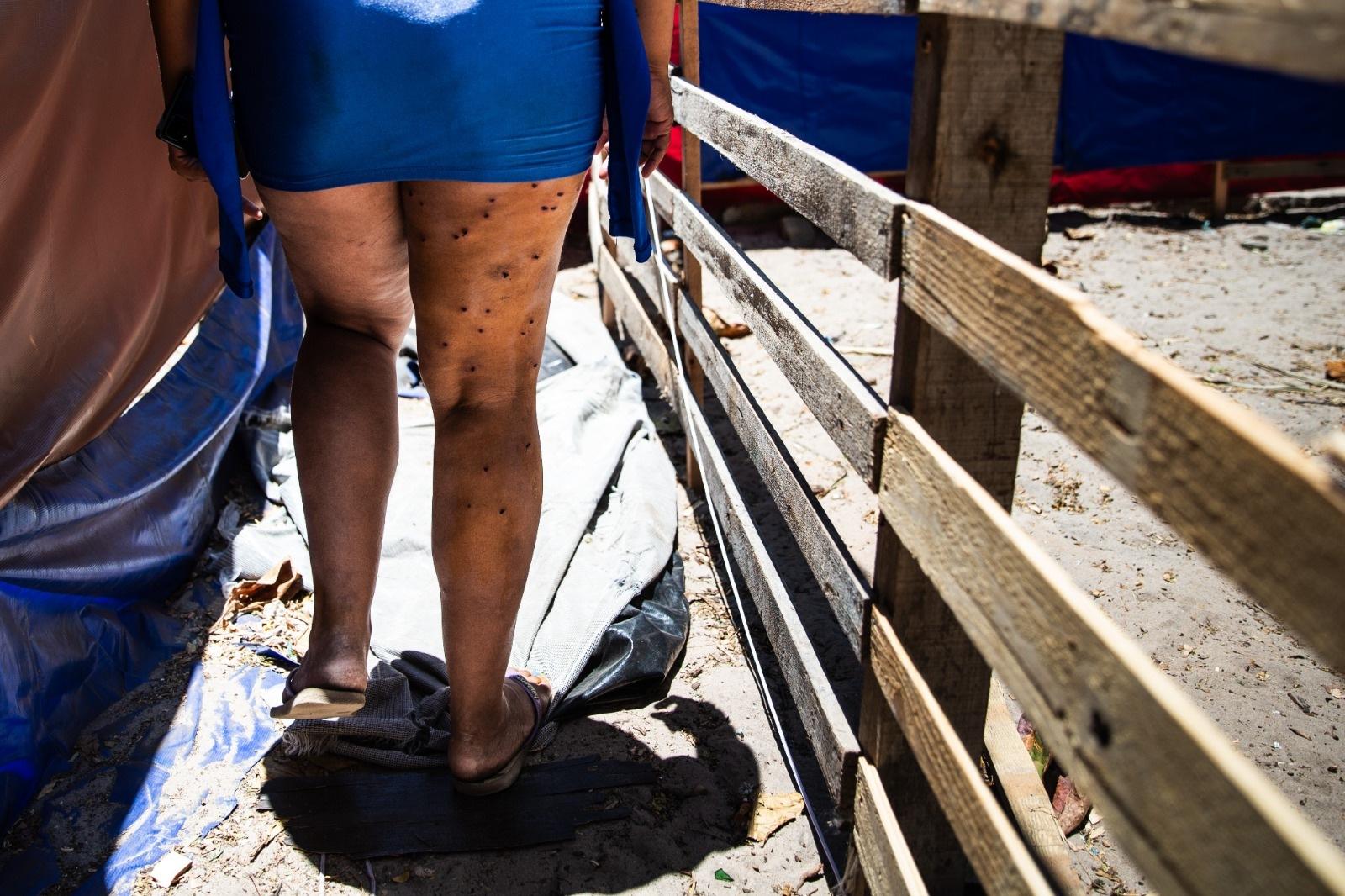 Mulher com marcas causadas por estilhaços, ferida durante desocupação