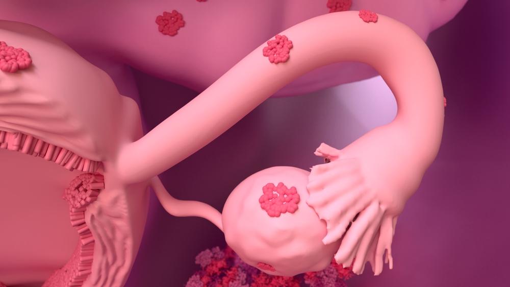 Representação gráfica de um útero com endometriose