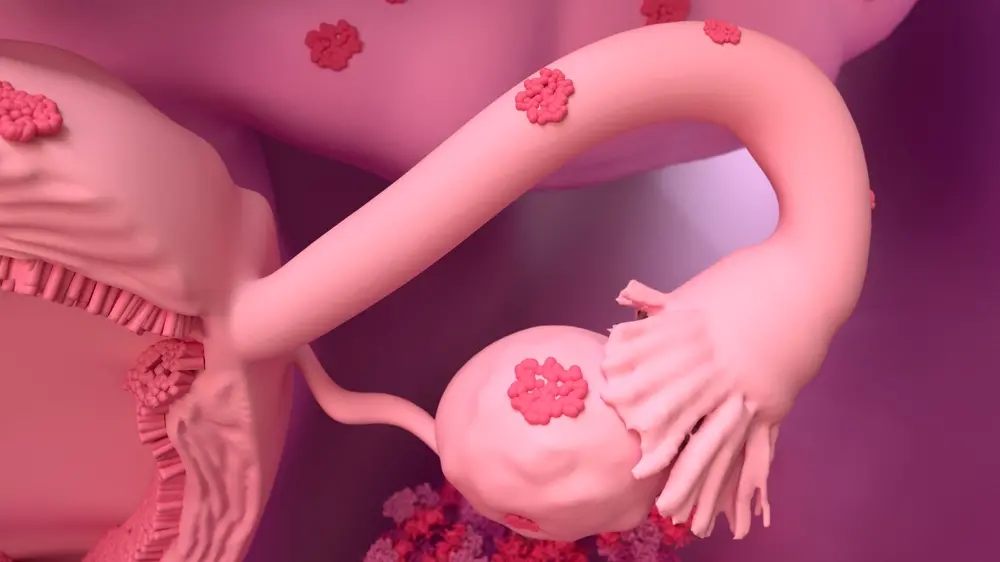 Representação gráfica de um útero com endometriose