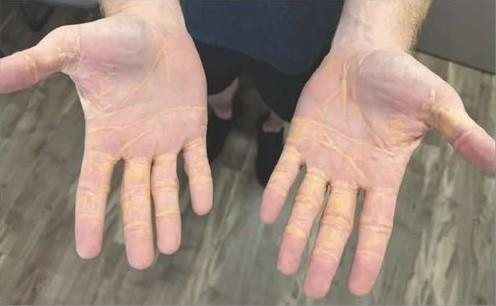 Homem nos EUA adquire secreção amarela nas mãos e nos pés após adotar 'dieta carnívora'