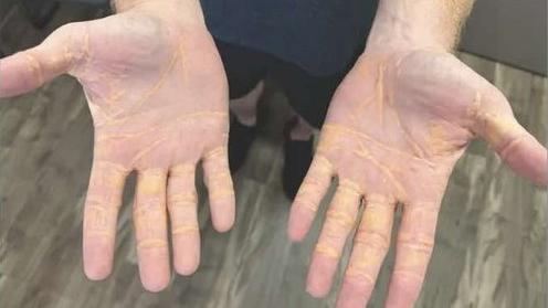 Homem nos EUA adquire secreção amarela nas mãos e nos pés após adotar 'dieta carnívora'