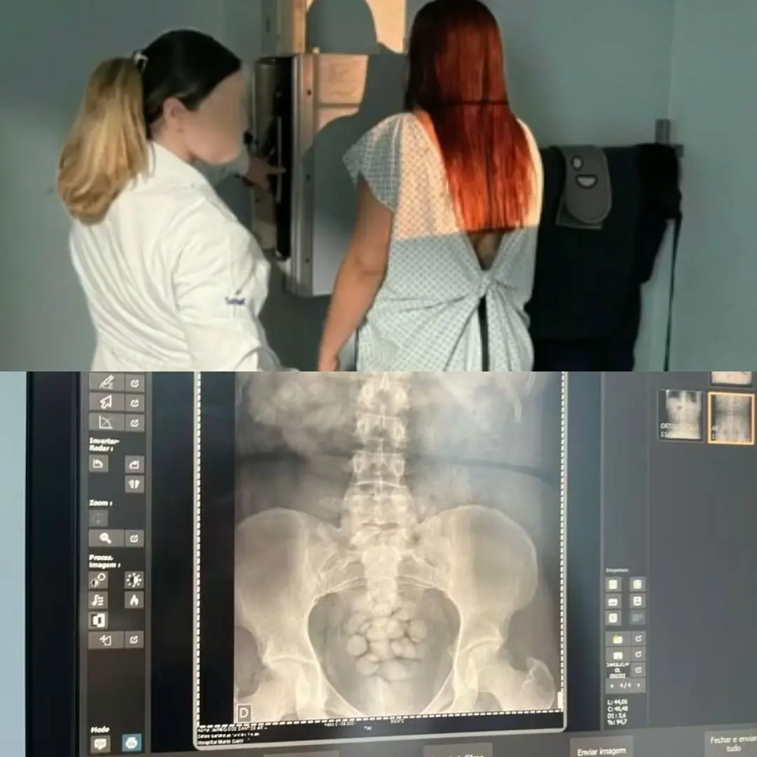 Montagem mostra a mulher fazendo exame e o raio-x tirado para identificar capsulas de cocaína em seu corpo