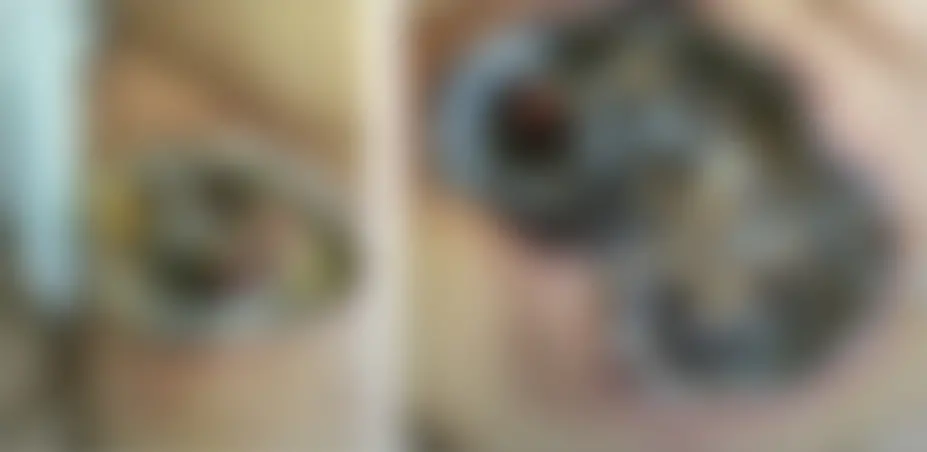 Imagem borrada de lesões escuras em paciente do sexo feminino com mucormicose no Ceará