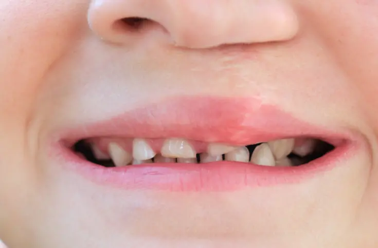 Sorriso de uma criança que fez cirurgia lábio palatino