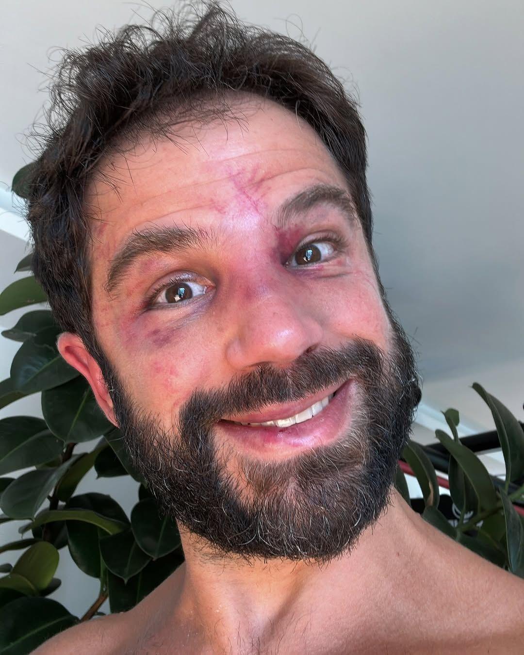 Duda Nagle mostra o rosto após a luta contra Popó