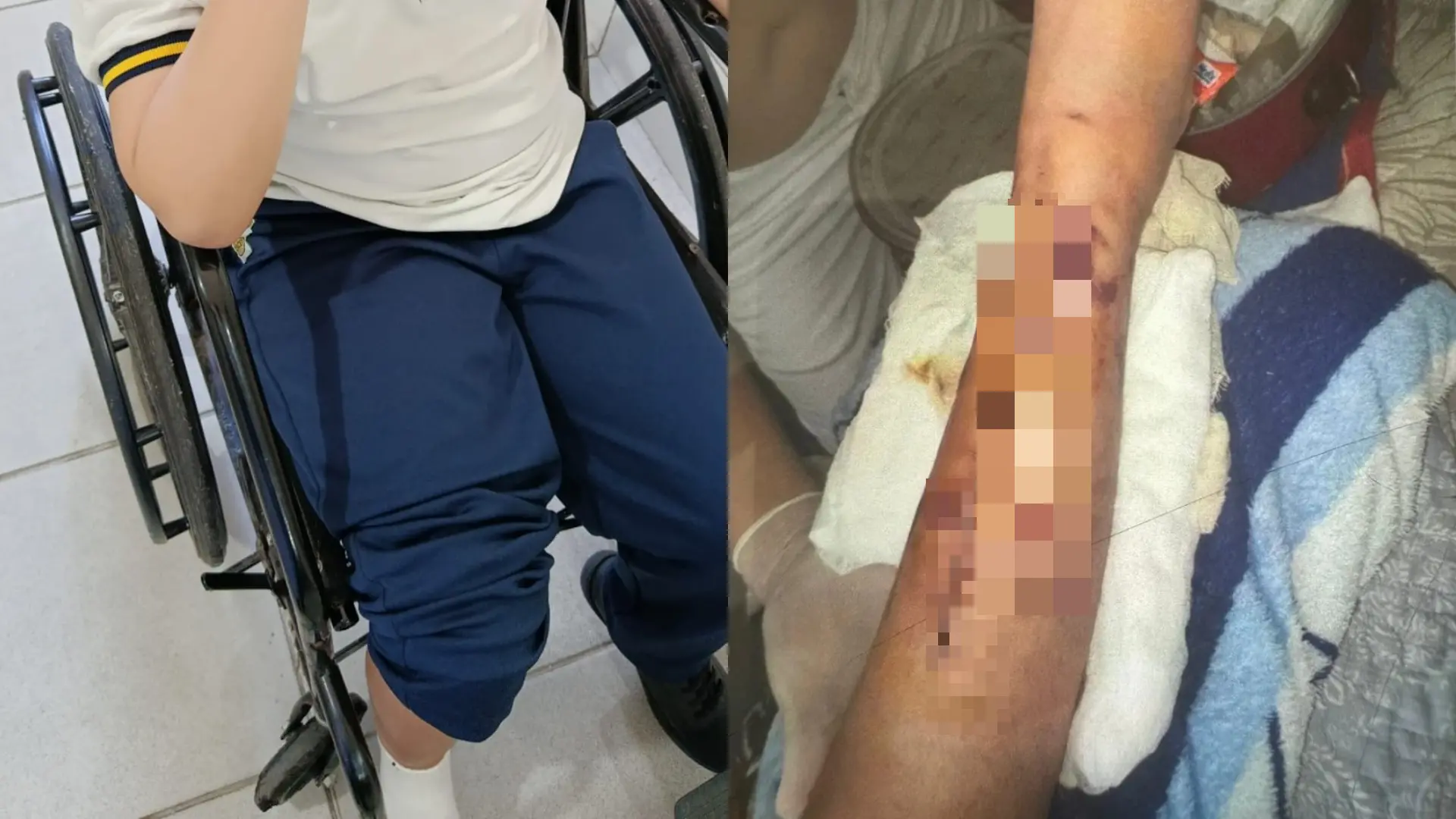 Garoto em atendimento médico em cadeira de rodas após sofrer queda e fraturar perna