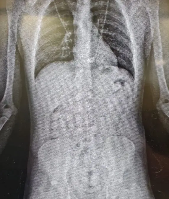 Cápsulas de cocaína vistas em raio-x feita pela Polícia Federal