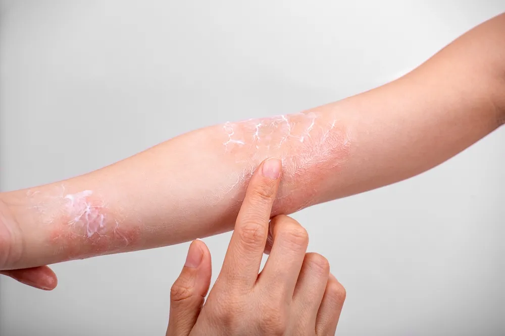 O tratamento da dermatite atópica pode incluir hidratantes, pomadas e medicamentos orais