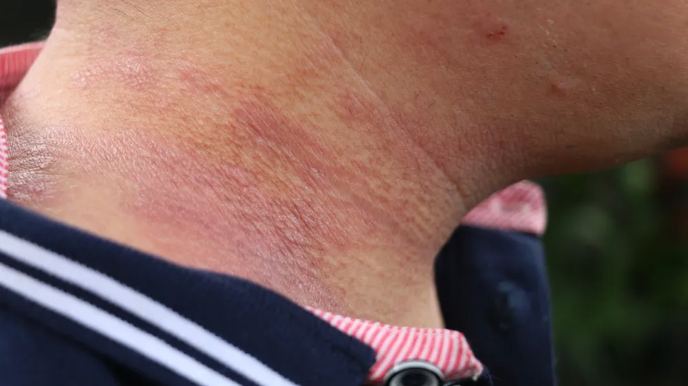 O pescoço é uma das áreas comumente afetadas pela condição