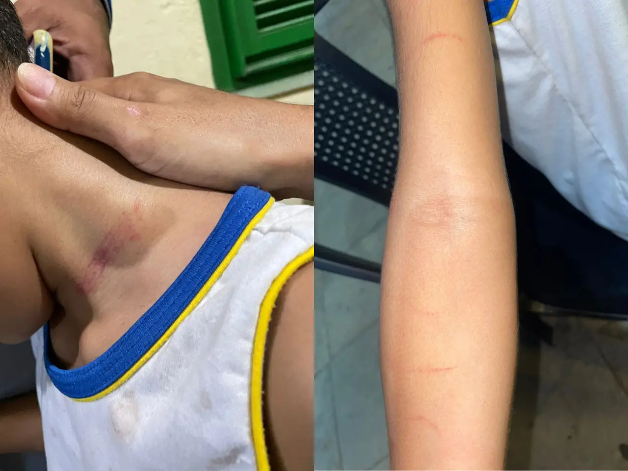 Fotos de marcas de agressão em criança autista agredida por cuidador em escola no Ceará