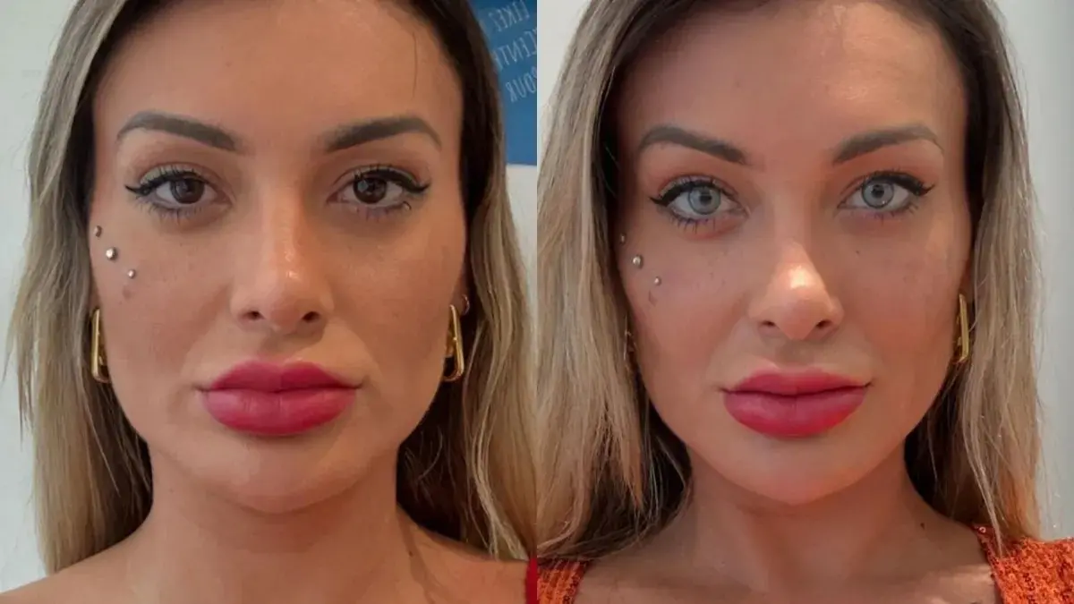 montagem de Andressa Urach mostrando resultado de cirurgia que muda a cor dos olhos