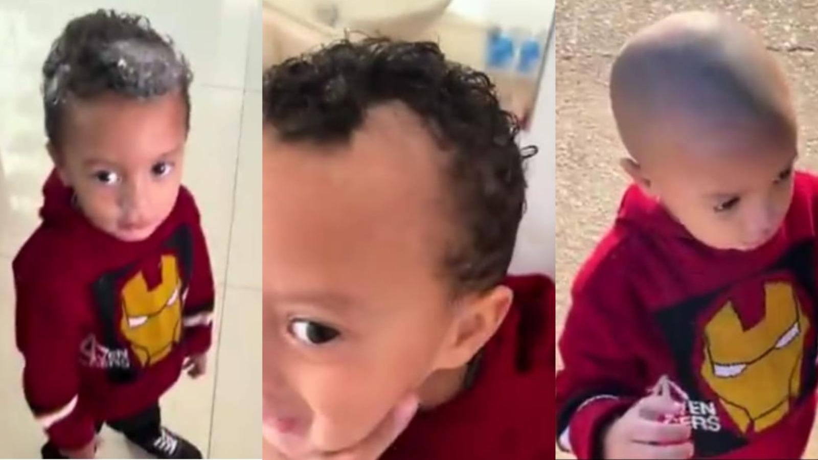 Imagens da criança Miguel depois de ter passado o creme depilatório na cabeça