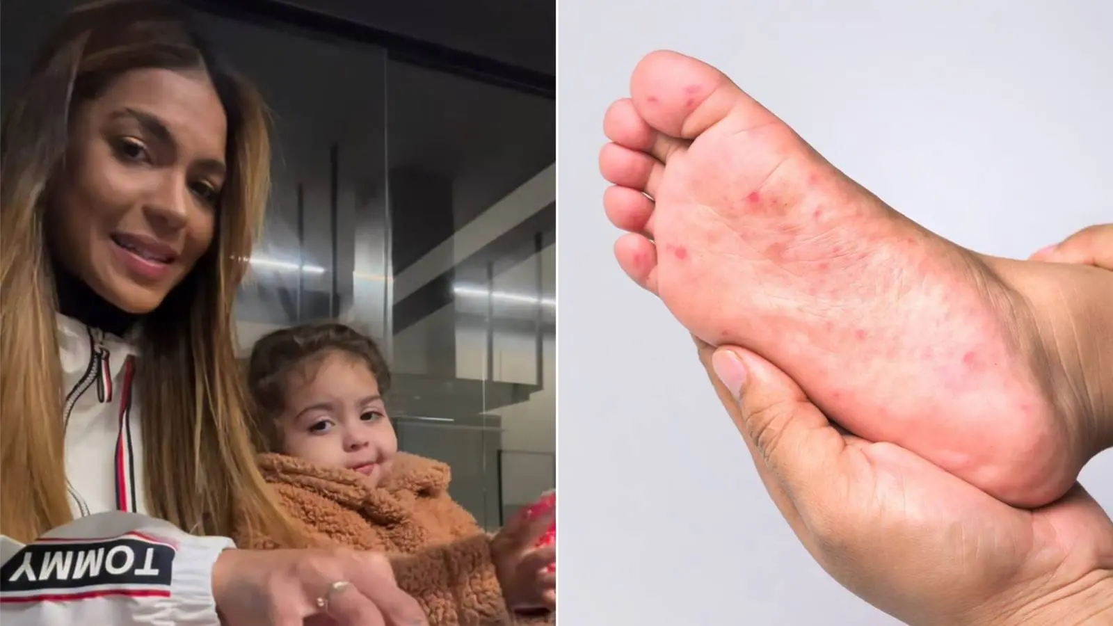 Imagem mostra Tays Reis e filha Pietra ao lado de foto de pé infantil com lesões de pé-mão-boca, diagnóstico confundido com febre aftosa