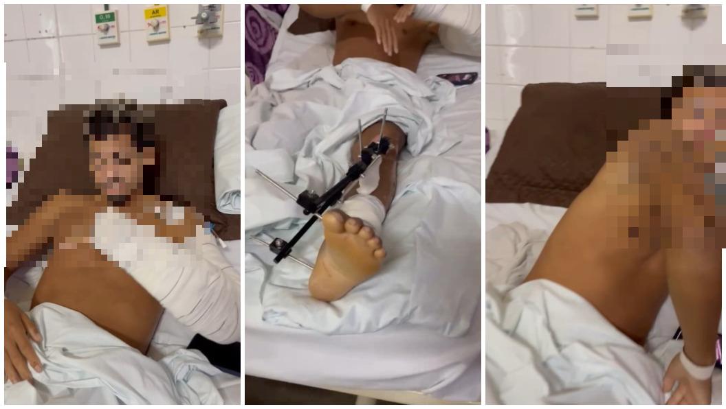 Igor Lima da Silva, que estava em colisão fatal no Meireles, mostra sequelas de acidente