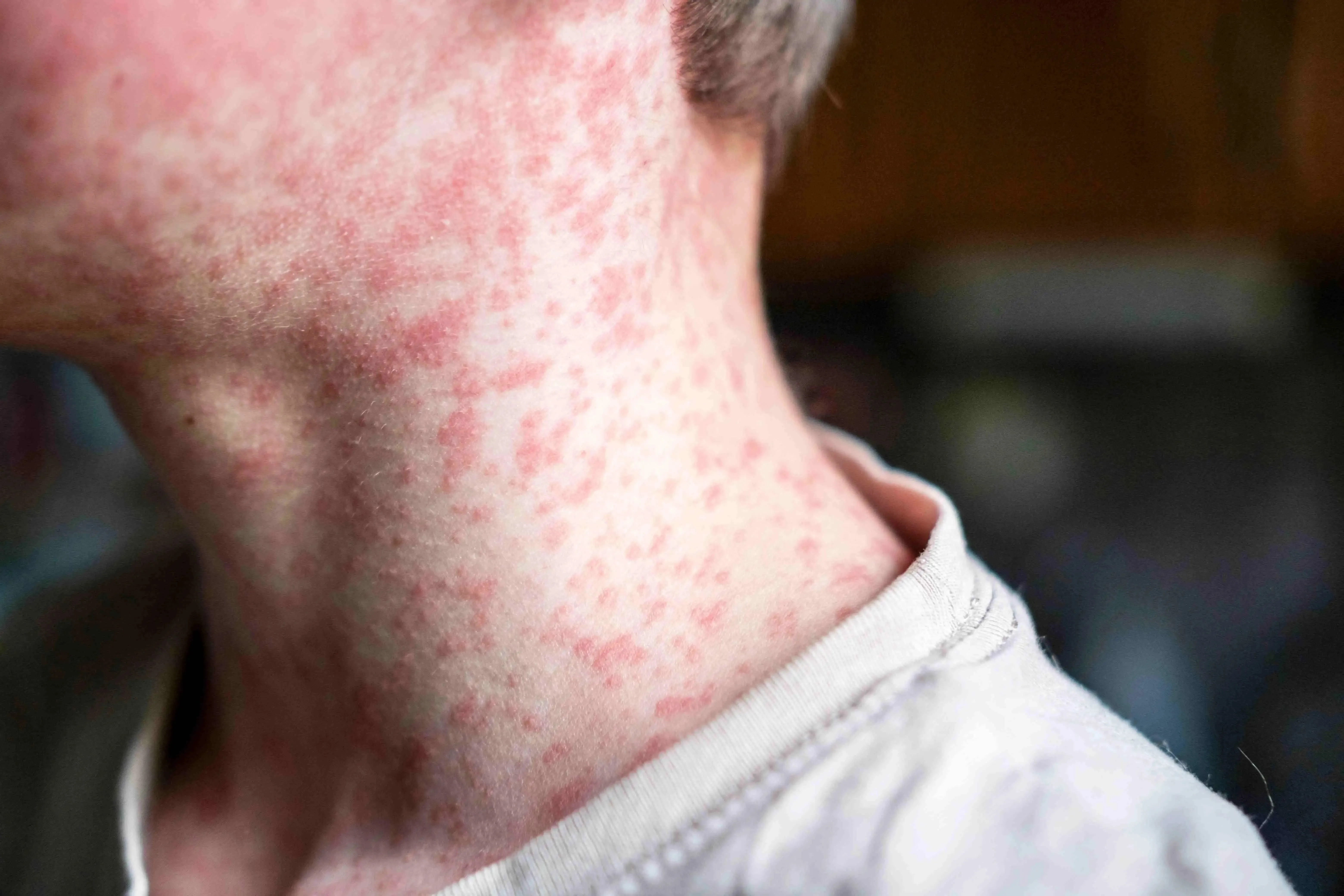 Manchas vermelhas pelo corpo é o principal sintoma de sarampo